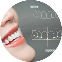 quy-trinh-veneer-2