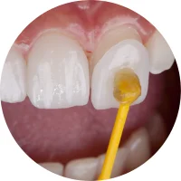 quy-trinh-veneer-4