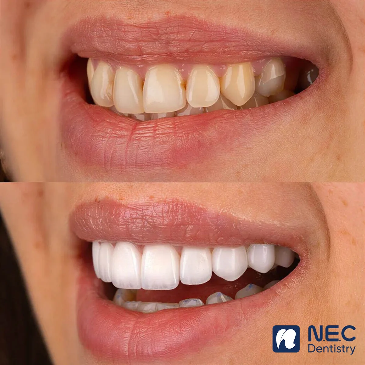 Dan-su-veneer-4