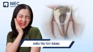 Dieu-tri-tuy-rang-0