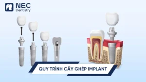 quy-trinh-cay-ghep-implant-0