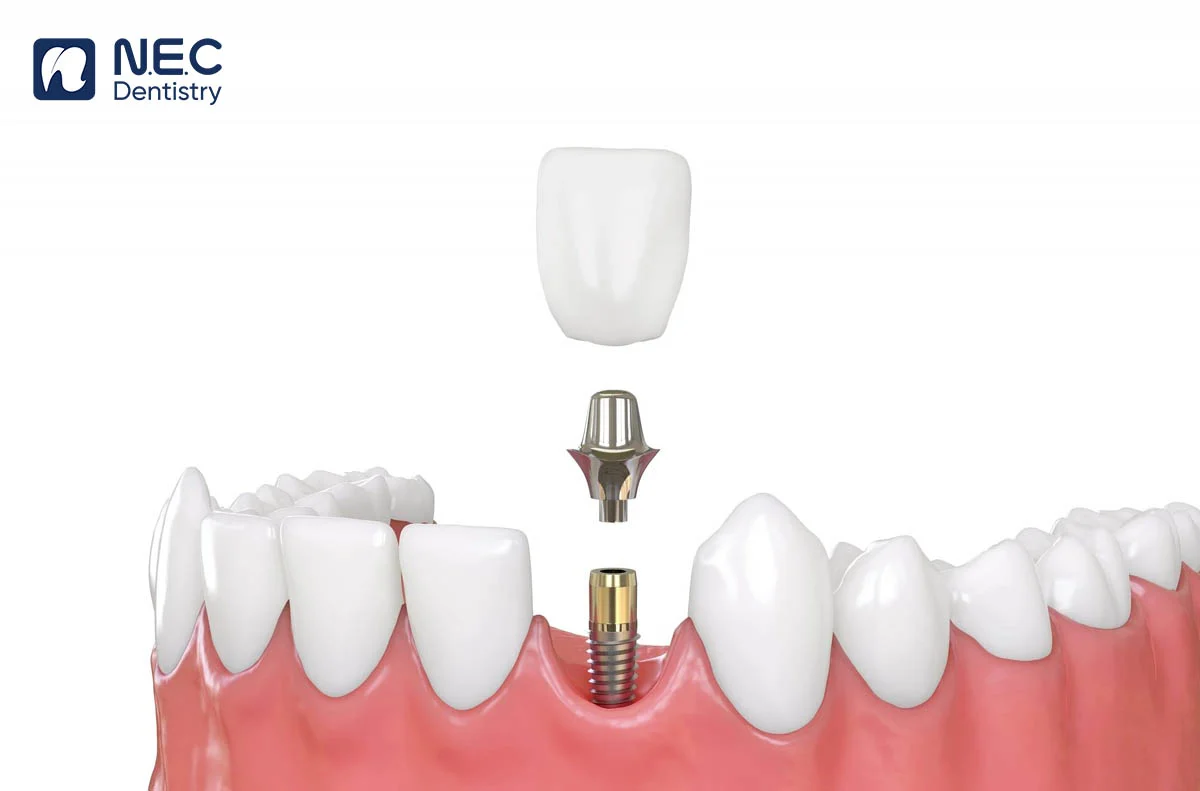 quy-trinh-cay-ghep-implant-1