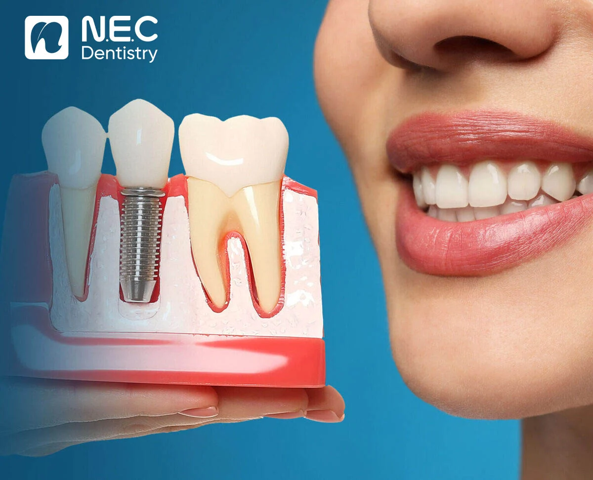 quy-trinh-cay-ghep-implant-2