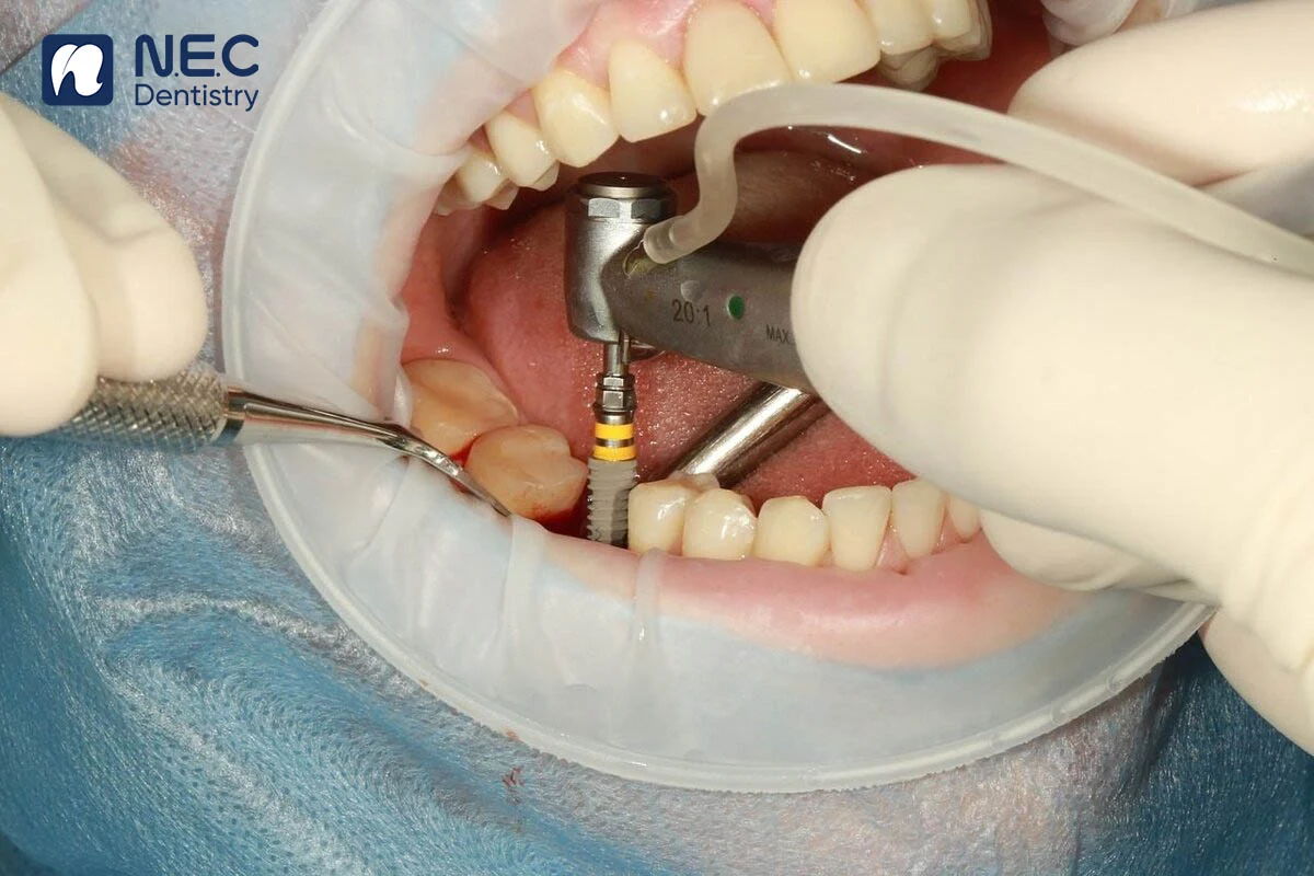 quy-trinh-cay-ghep-implant-4
