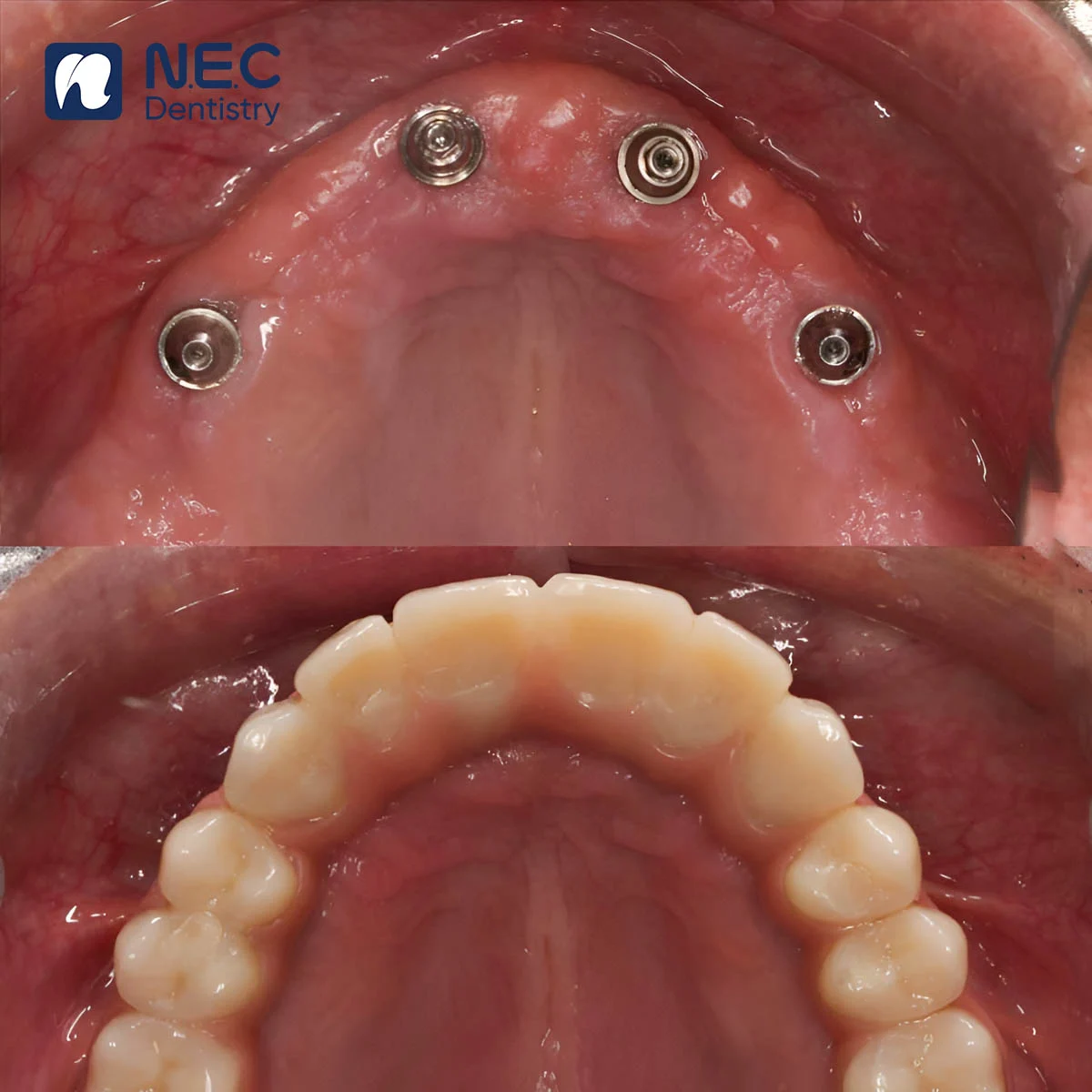 quy-trinh-cay-ghep-implant-7